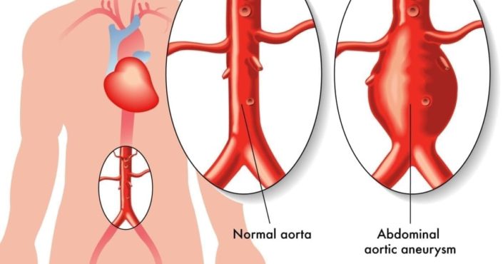 Illustration of a human body with close-ups of a normal aorta and one with an abdominal aortic aneurysm