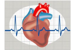 Illustration of cardiac arrhythmia