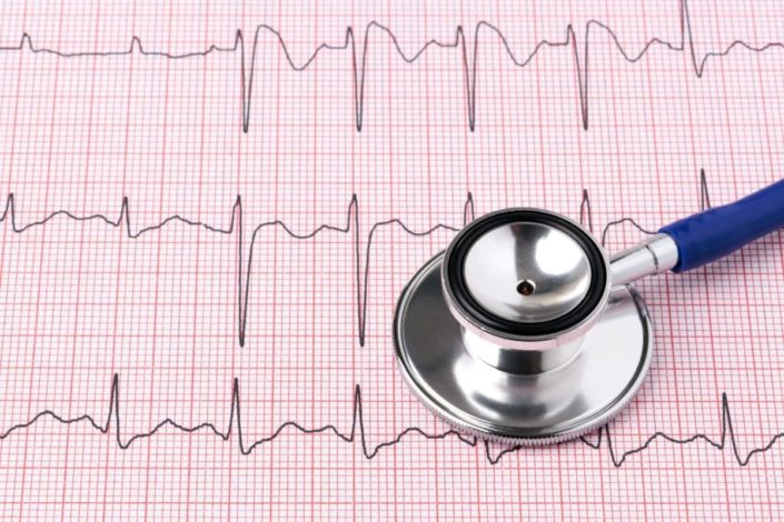 Photo of an electrocardiogram ecg or ekg printout with stethoscope. Heart palpitations is a condition that feels like your heart is pounding, racing, or skipping beats (fluttering).