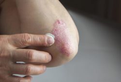 Woman applying lotion to psoriasis on her elbow