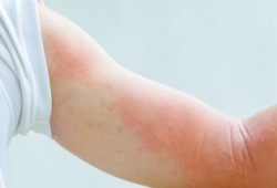 close up image of a man's body suffering severe urticaria nettle rash.