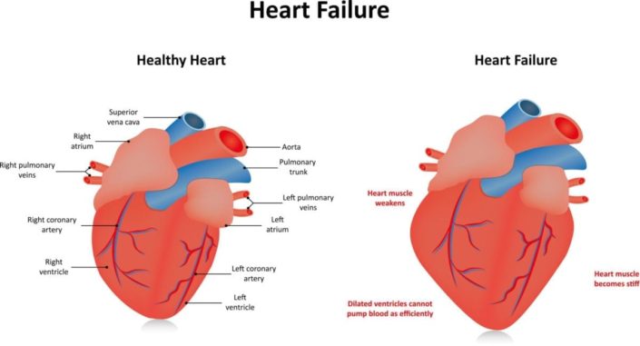 side-by-side diagrams of a healthy heart and one with heart failure