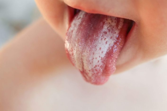 Baby sticking out tongue with white coating from oral thrush