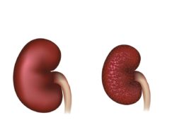 Image showing normal kidney and one with diabetic nephropathy