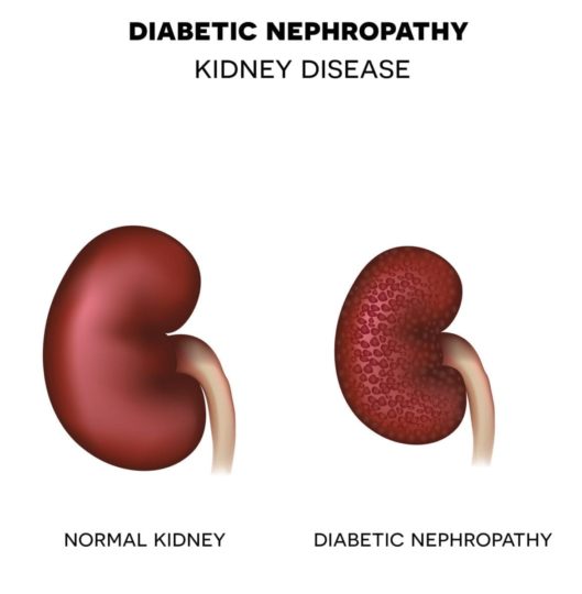 Image showing normal kidney and one with diabetic nephropathy