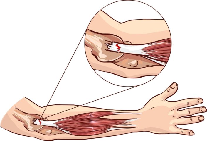 Tennis elbow - tear in the common extensor tendon of the arm