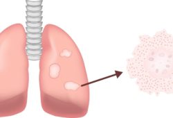 Lung Illustration