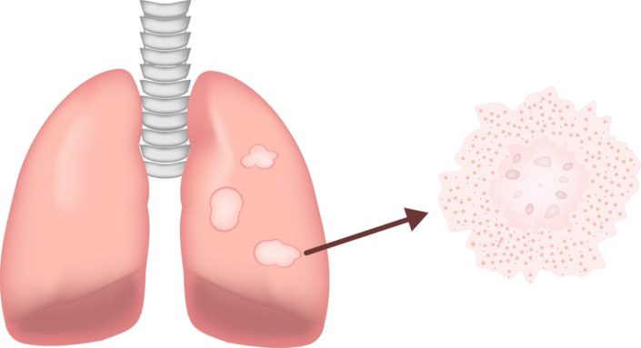 Lung Illustration