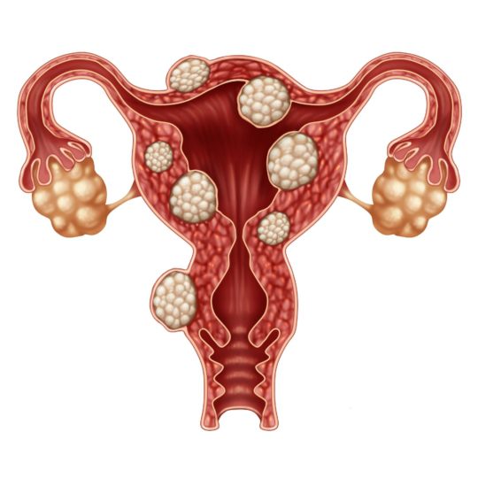 A medical drawing of uterine fibroids in and around the uterus.