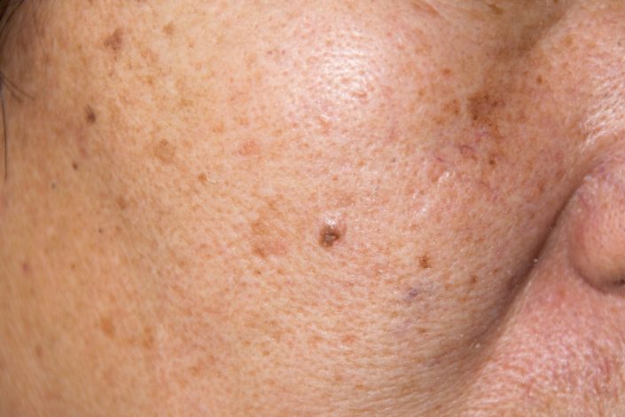 close-up of a person’s cheek with small patches of melasma