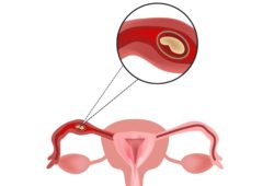 Illustration of female reproductive system with a close-up on an embryo developing in the fallopian tube. An ectopic pregnancy happens when a fertilized egg grows outside the uterus. It can be dangerous to the mother if not treated early enough.