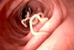 Tapeworm in human intestine