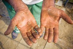 Worker shows his chapped, injured, and dirty palms