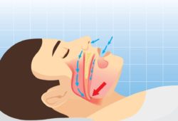 diagram showing interrupted airflow during sleep