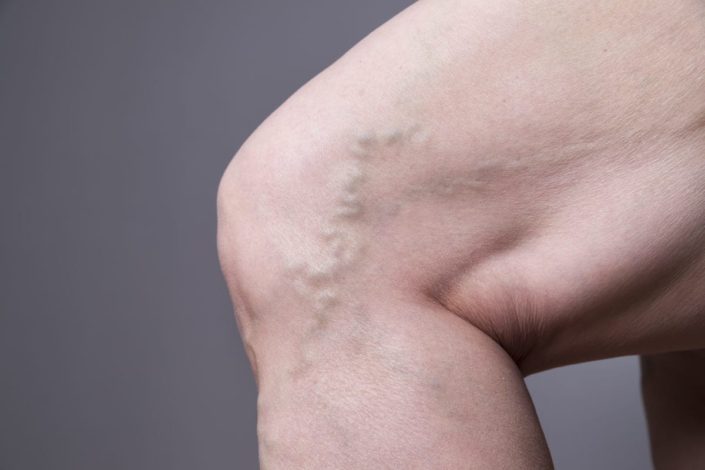 A varicose vein is visible on the side of a woman’s knee