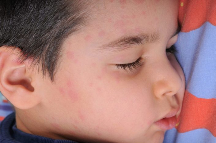 Little boy sleeping in his bed suffering from hives