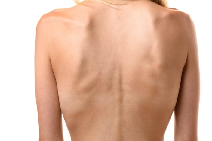 Rear view of the back of a thin woman showing ribs and spine