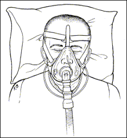 CPAP Face mask illustration